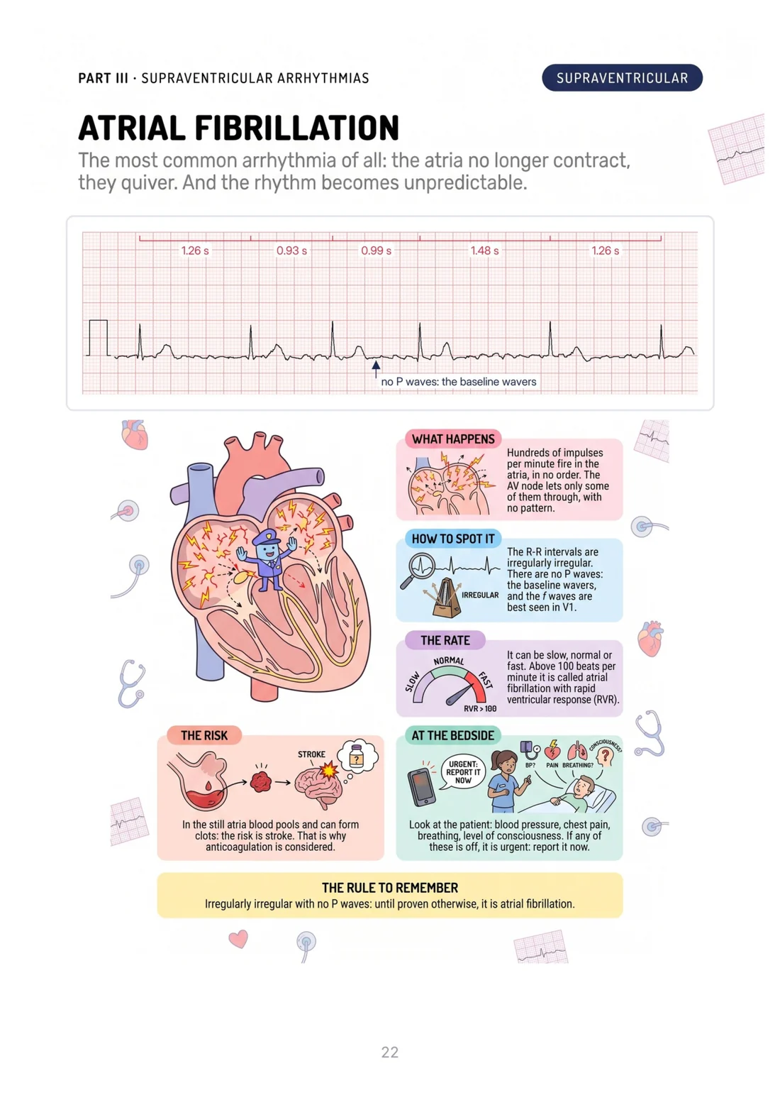 Atrial fibrillation