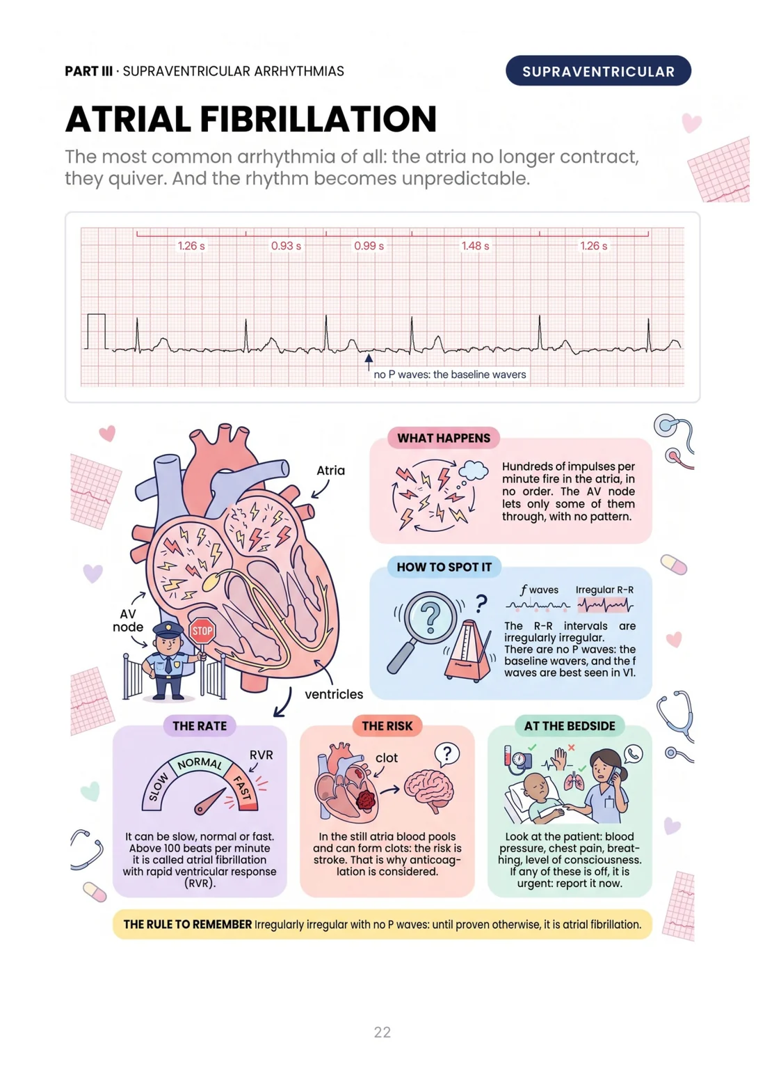 Atrial fibrillation